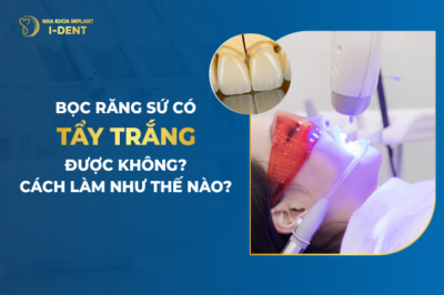 Bọc răng sứ có tẩy trắng được không- Cách làm như thế nào-