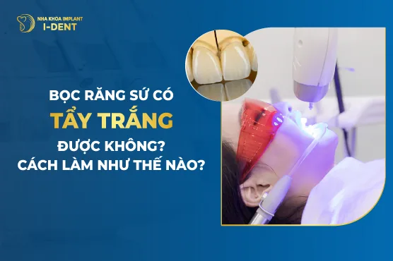 Bọc răng sứ có tẩy trắng được không- Cách làm như thế nào-