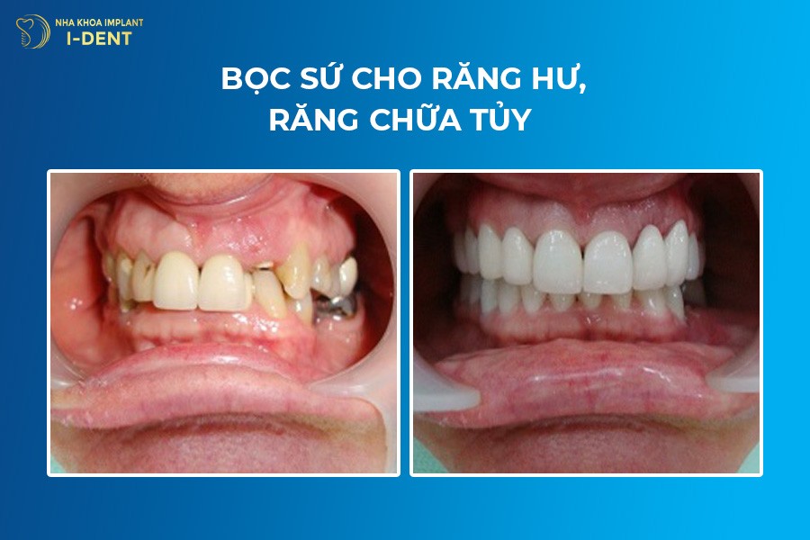 có nên bọc răng sứ không