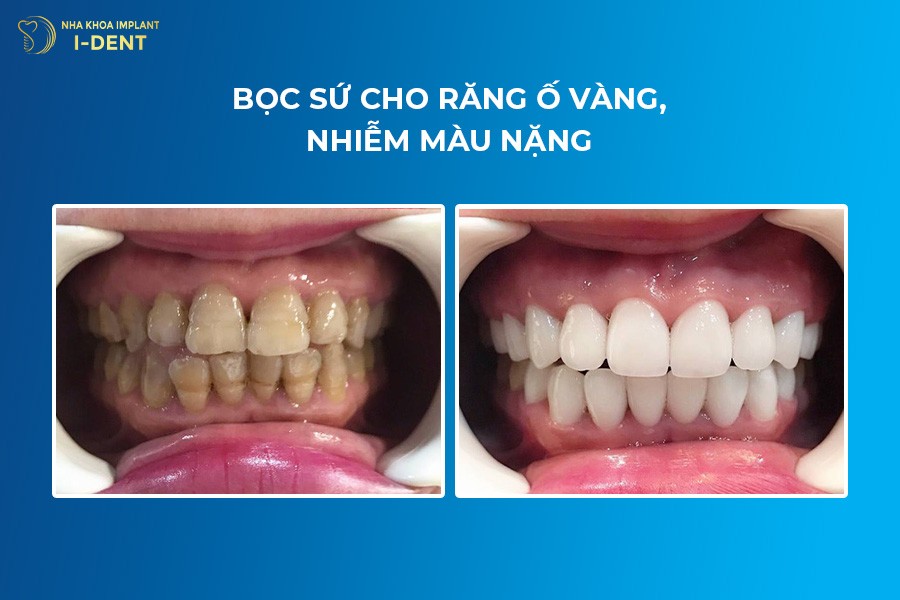 khi nào nên bọc răng sứ