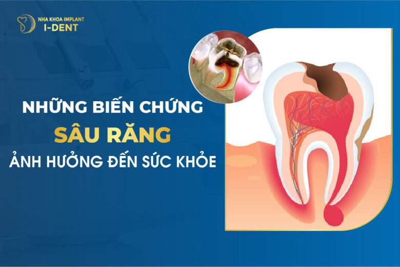 Các Biến Chứng Sâu Răng Ảnh Hưởng Đến Sức Khỏe
