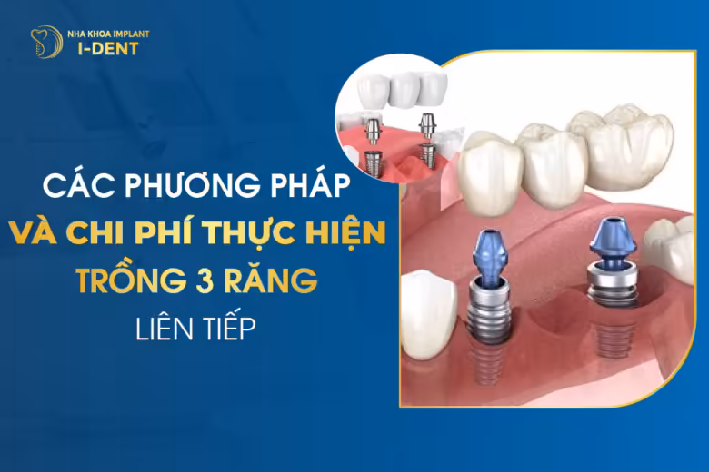 Các Phương Pháp Và Chi Phí Thực Hiện Trồng 3 Răng Liên Tiếp