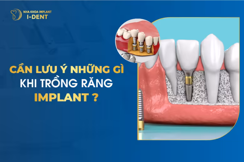 Cần Lưu Ý Những Gì Khi Trồng Răng Implant