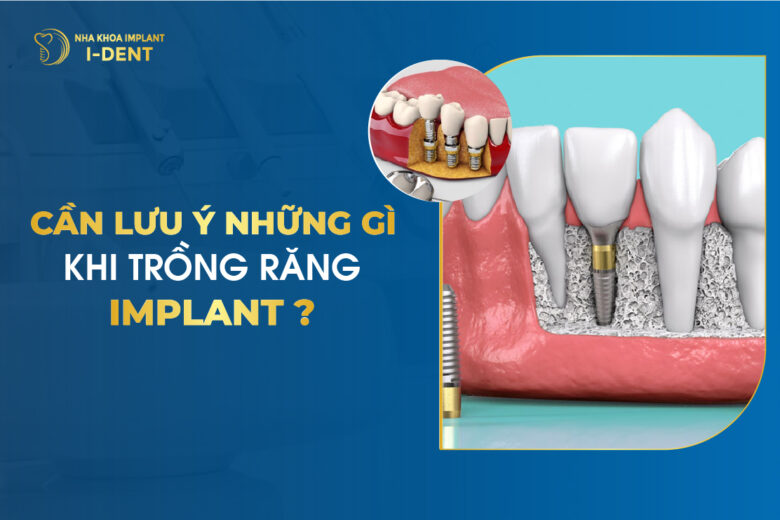 Cần Lưu Ý Những Gì Khi Trồng Răng Implant?