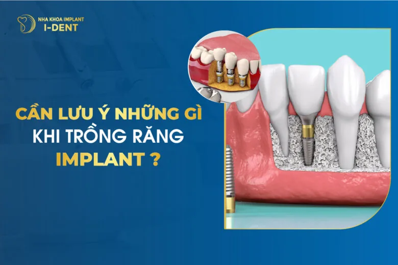 Cần Lưu Ý Những Gì Khi Trồng Răng Implant