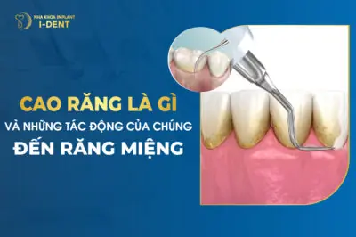 Cao Răng Là Gì Và Những Tác Động Của Chúng Đến Răng Miệng