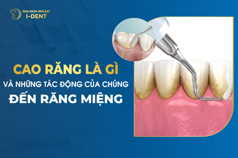 Cao Răng Là Gì Và Những Tác Động Của Chúng Đến Răng Miệng