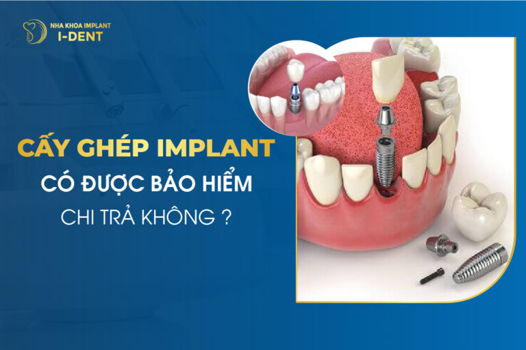 Cấy Ghép Implant Có Được Bảo Hiểm Chi Trả Hay Không