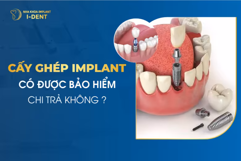 Cấy Ghép Implant Có Được Bảo Hiểm Chi Trả Hay Không