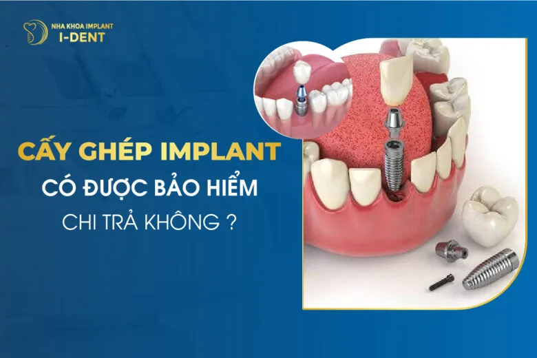Cấy Ghép Implant Có Được Bảo Hiểm Chi Trả Hay Không