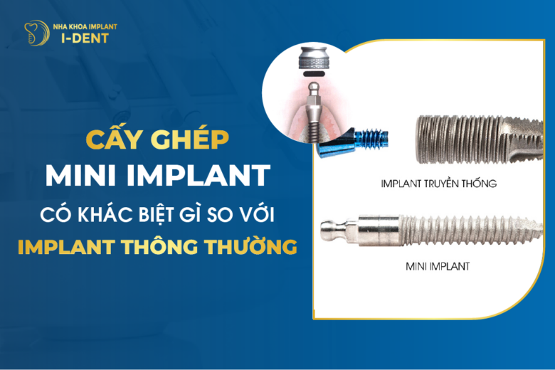 Cấy Ghép Mini Implant Có Khác Biệt Gì So Với Implant Thông Thường?