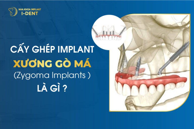 Cấy ghép Implant xương gò má (Zygoma Implants) là gì