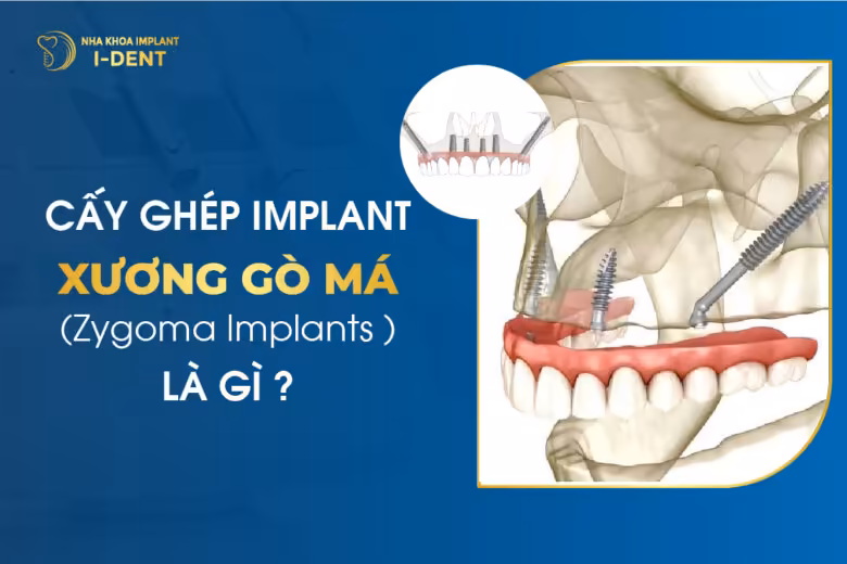 Cấy ghép Implant xương gò má (Zygoma Implants) là gì