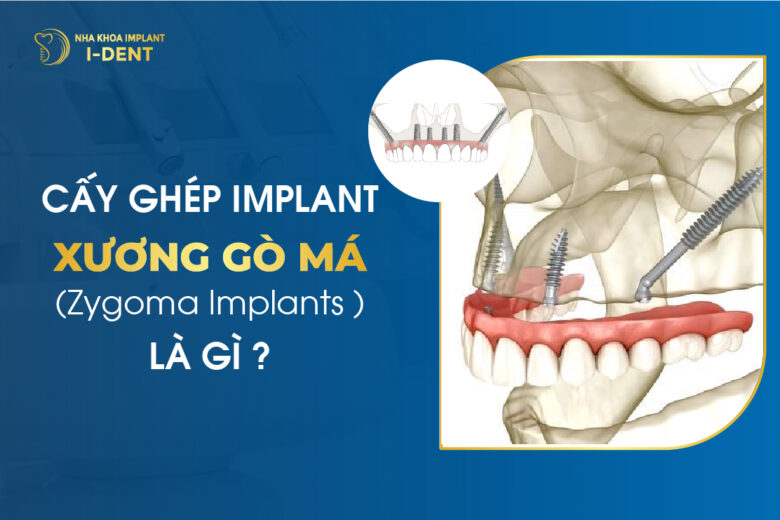 Cấy ghép Implant xương gò má (Zygoma Implants) là gì?