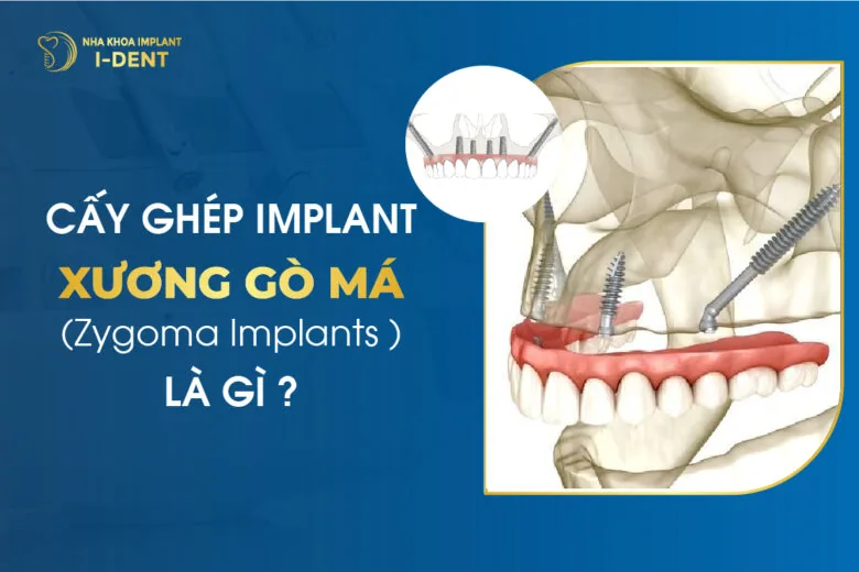 Cấy ghép Implant xương gò má (Zygoma Implants) là gì