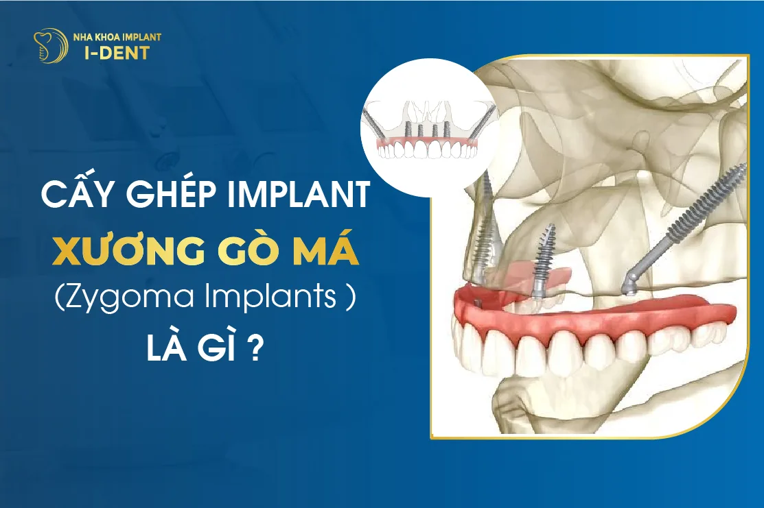 Cấy ghép Implant xương gò má (Zygoma Implants) là gì