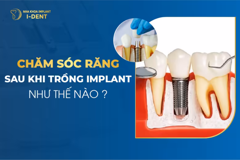 Cấy ghép Implant xương gò má (Zygoma Implants) là gì