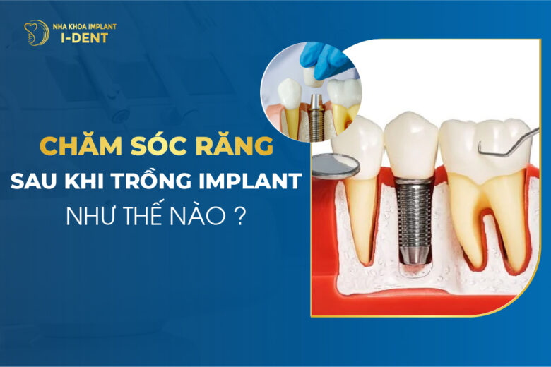 Chăm Sóc Răng Sau Khi Trồng Implant Như Thế Nào?