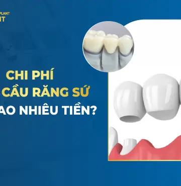 Làm Cầu Răng Sứ Giá Bao Nhiêu Tiền?