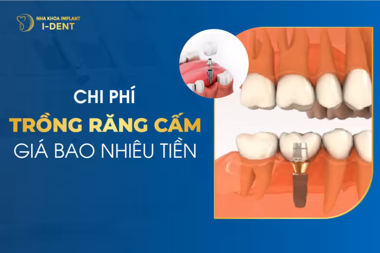 trồng răng cấm giá bao nhiêu
