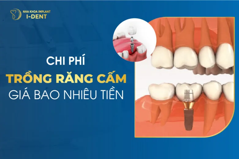 trồng răng cấm giá bao nhiêu