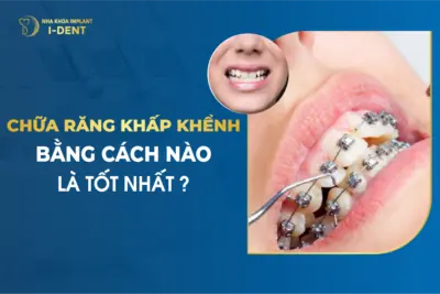 Chữa Răng Khấp Khểnh Bằng Cách Nào Là Tốt Nhất