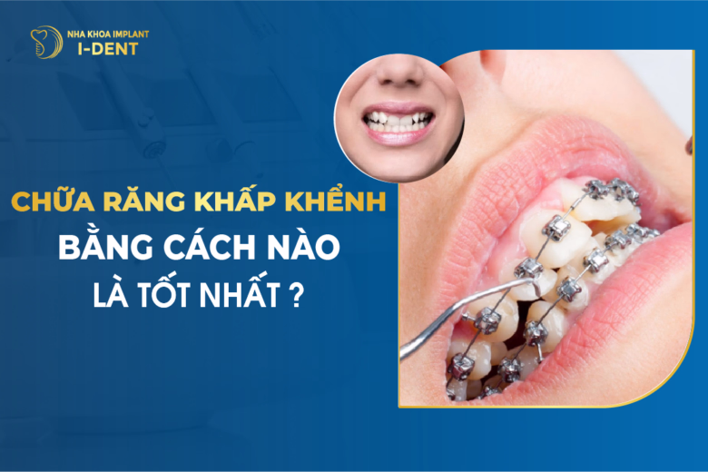 Chữa Răng Khấp Khểnh Bằng Cách Nào Là Tốt Nhất