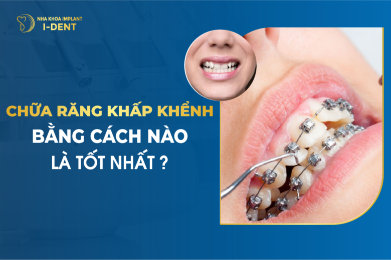 Chữa Răng Khấp Khểnh Bằng Cách Nào Là Tốt Nhất?