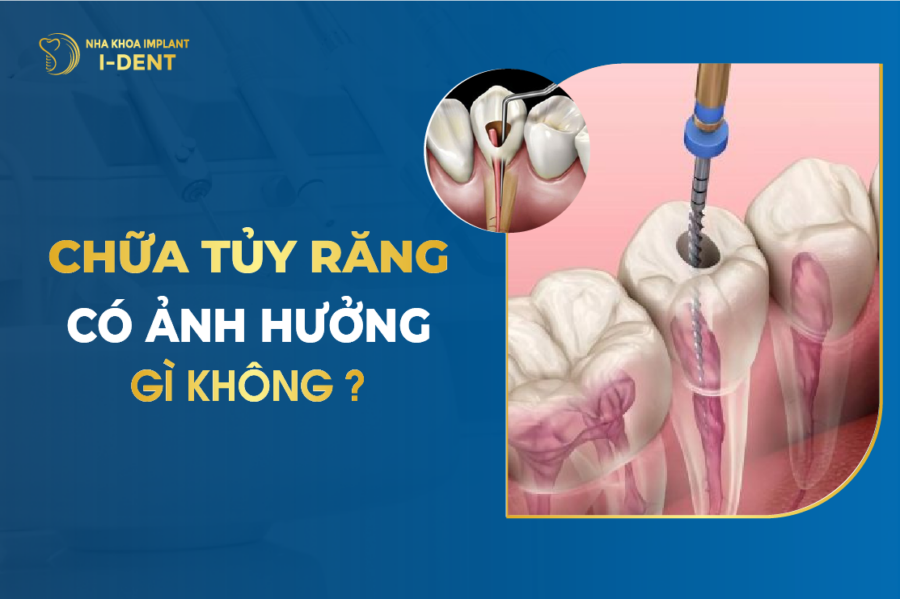 Lấy Tủy Răng Là Gì? Diệt Tủy Răng Có Ảnh Hưởng Gì Không?