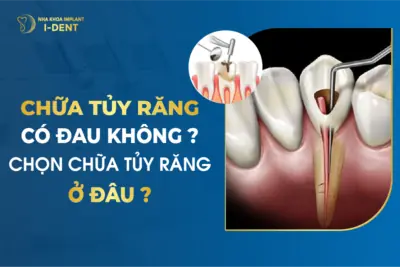 Chữa Tủy Răng Có Đau Không? Chọn Chữa Tủy Răng Ở Đâu?