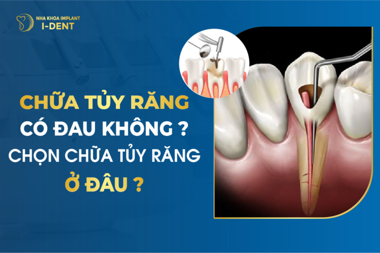 Lấy Tủy Răng Có Đau Không? Chọn Chữa Tủy Răng Ở Đâu?