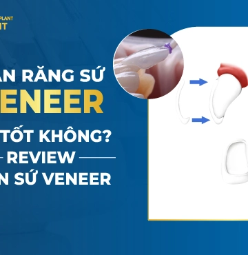 Dán Răng Sứ Veneer Có Tốt Không- Review Dán Sứ Veneer