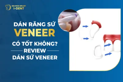 Dán Răng Sứ Veneer Có Tốt Không- Review Dán Sứ Veneer