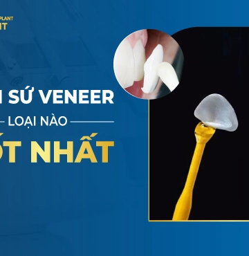 Dán Sứ Veneer Loại Nào Tốt Nhất?