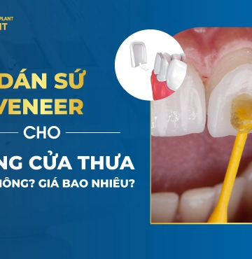 Dán sứ veneer cho 2 răng cửa thưa được không- Giá bao nhiêu-