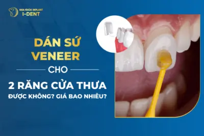 Dán sứ veneer cho 2 răng cửa thưa được không- Giá bao nhiêu-