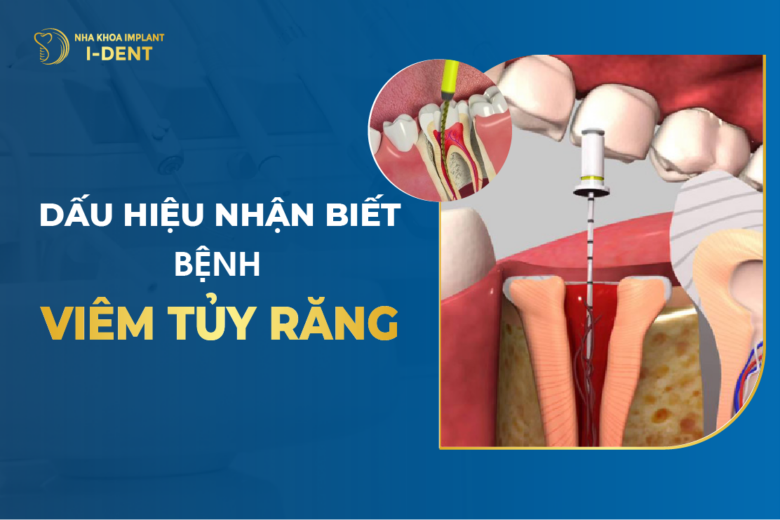 Dấu Hiệu Nhận Biết Bệnh Viêm Tủy Răng