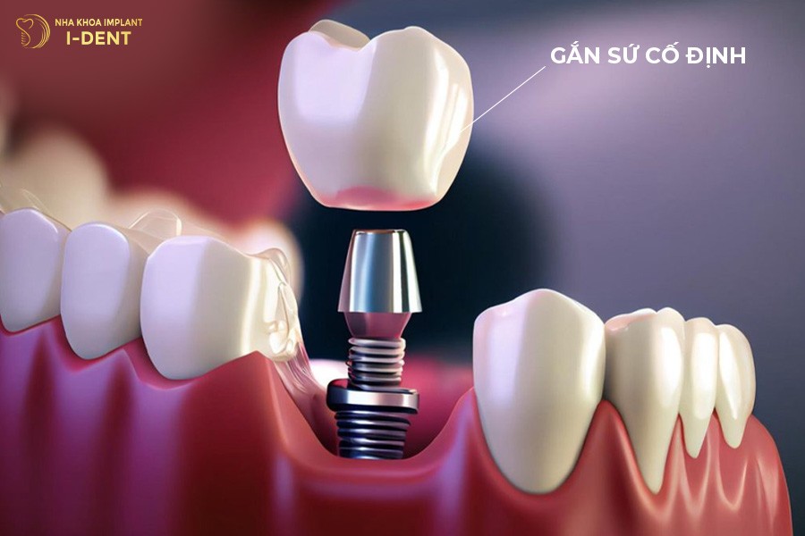 trồng răng bằng phương pháp implant