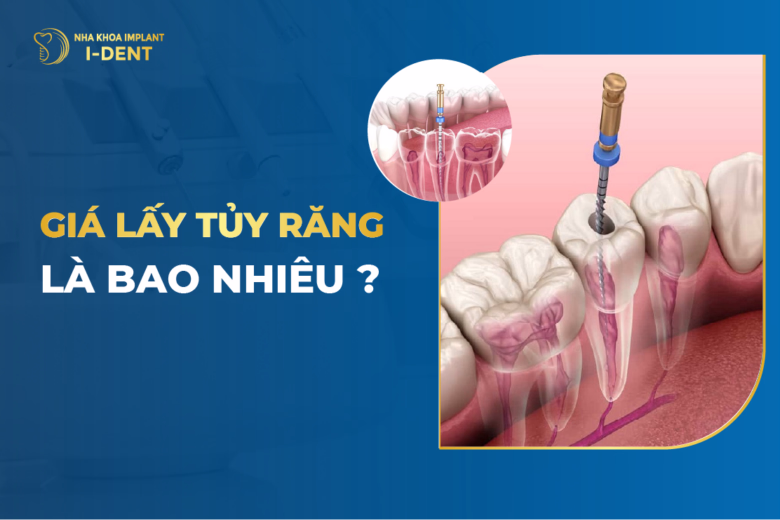 Dấu Hiệu Nhận Biết Bệnh Viêm Tủy Răng