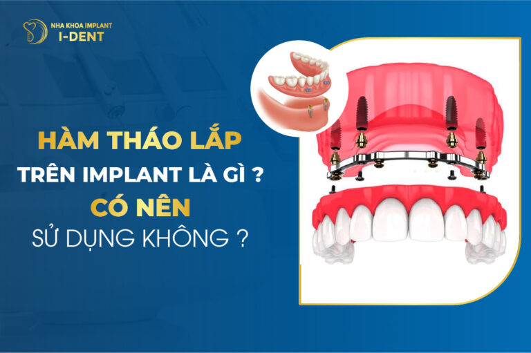 Hàm Tháo Lắp Trên Implant Là Gì Có Nên Sử Dụng Không