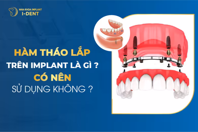 Hàm Tháo Lắp Trên Implant Là Gì Có Nên Sử Dụng Không