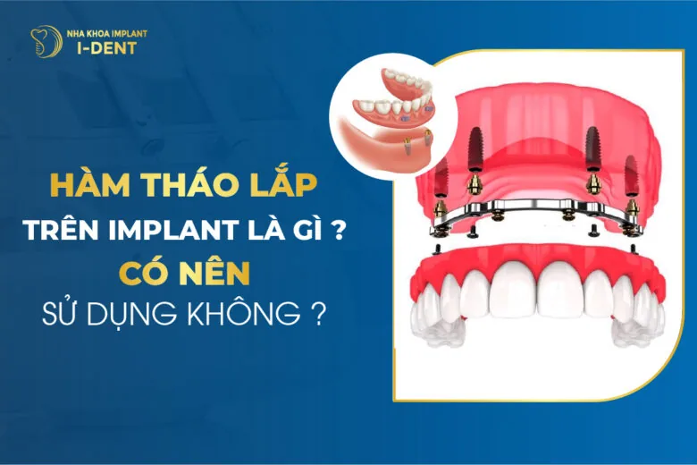 Hàm Tháo Lắp Trên Implant Là Gì Có Nên Sử Dụng Không