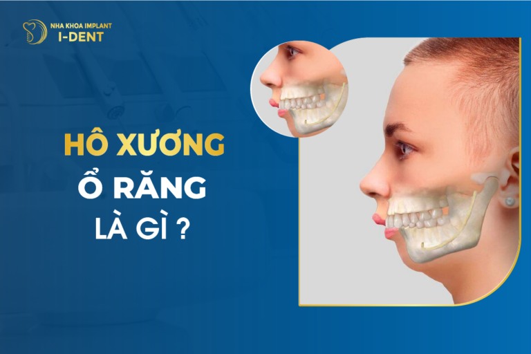 Hô Xương Ổ Răng Là Gì