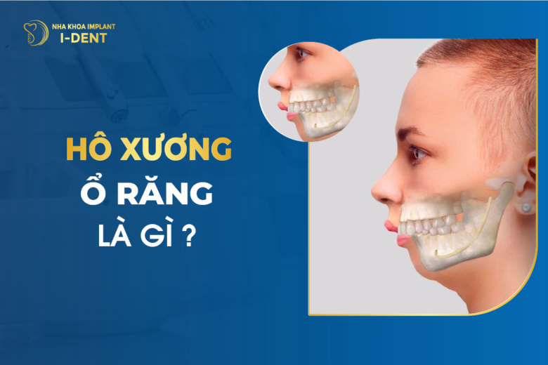 Hô Xương Ổ Răng Là Gì