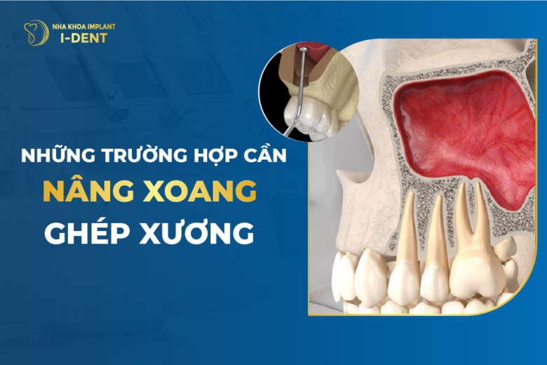 Những Trường Hợp Cần Nâng Xoang Ghép Xương