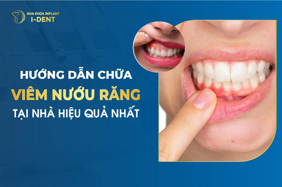 Hướng Dẫn Cách Chữa Viêm Nướu Răng Tại Nhà Hiệu Quả Nhất