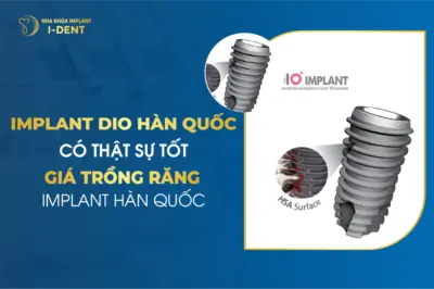 Implant Dio Hàn Quốc Có Thật Sự Tốt - Giá Trồng Răng Implant Hàn Quốc