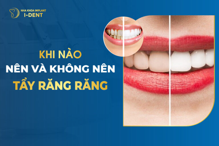 Khi Nào Nên Và Không Nên Tẩy Trắng Răng