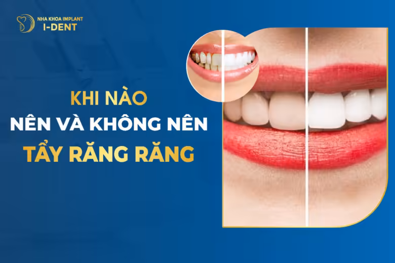 Khi Nào Nên Và Không Nên Tẩy Trắng Răng