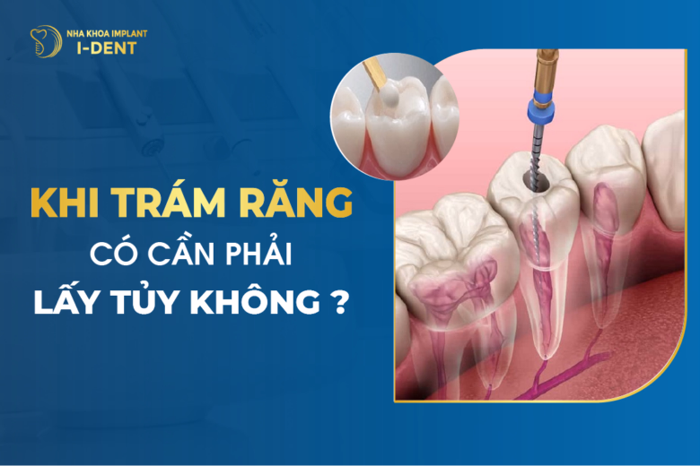 Khi Trám Răng Có Cần Phải Lấy Tủy Không
